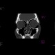 Fracture of orbital floor, tear-drop figure, hemosinus: CT - Computed tomography