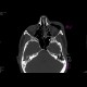 Fracture of orbital floor, tear-drop figure, hemosinus: CT - Computed tomography