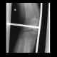 Fracture of tibia: X-ray - Plain radiograph