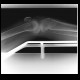Fracture of tibia: X-ray - Plain radiograph