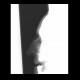 Fracture of nasal bones, comminuted: X-ray - Plain radiograph