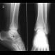 Fracture of fibular ankle, Weber B: X-ray - Plain radiograph