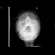 Fracture of the left zygomaticomaxillary complex (ZMK), hemosinus: X-ray - Plain radiograph