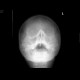Fracture of zygomaticomaxillary complex, ZMK: X-ray - Plain radiograph