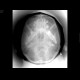 Fracture of zygomaticomaxillary complex, ZMK: X-ray - Plain radiograph