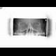 Fracture of zygomaticomaxillary complex, ZMK: X-ray - Plain radiograph