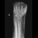 Fracture of distal metaepiphysis of the radius (Colles fracture) - after reposition: X-ray - Plain radiograph