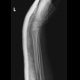 Fracture of distal metaepiphysis of the radius (Colles fracture) - after reposition: X-ray - Plain radiograph