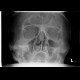 Comminuted fracture of frontal sinus, hemosinus: X-ray - Plain radiograph