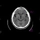 Comminuted fracture of frontal sinus, hemosinus: CT - Computed tomography