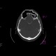 Comminuted fracture of frontal sinus, hemosinus: CT - Computed tomography