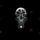 Comminuted fracture of frontal sinus, hemosinus: CT - Computed tomography