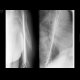 Fracture of the shaft of humerus, osteosynthesis with K wires: X-ray - Plain radiograph