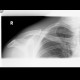 Fracture of collar bone, clavicle: X-ray - Plain radiograph