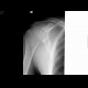 Fracture of scapula, shoulder blade: X-ray - Plain radiograph