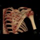 Fracture of scapula, shoulder blade, VRT: CT - Computed tomography