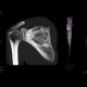 Fracture of scapula, shoulder blade, MIP: CT - Computed tomography