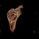 Fracture of scapula, shoulder blade, VRT: CT - Computed tomography
