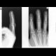 Fracture of the distal phalangeal tuberosity: X-ray - Plain radiograph