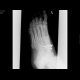 Fracture of navicular bone and metatarsal bones: X-ray - Plain radiograph