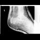 Fracture of calcaneus: X-ray - Plain radiograph