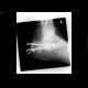 Fracture of calcaneus: X-ray - Plain radiograph