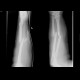 Fracture of forearm bones, ulna and radius: X-ray - Plain radiograph