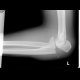 Fracture of foream bones: X-ray - Plain radiograph