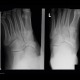 Fracture of tarsal bones: X-ray - Plain radiograph