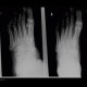 Fracture of tarsal bones: X-ray - Plain radiograph