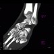 Fracture of tarsal bones: CT - Computed tomography