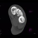 Fracture of tarsal bones: CT - Computed tomography