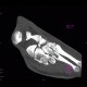 Fracture of tarsal bones: CT - Computed tomography