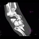 Fracture of tarsal bones: CT - Computed tomography