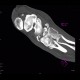 Fracture of tarsal bones: CT - Computed tomography