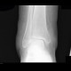 Fracture of tibial malleolus: X-ray - Plain radiograph