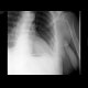 Rib fracture: X-ray - Plain radiograph