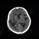 Stroke, brain ischemia, fresh: CT - Computed tomography