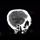 Stroke, brain ischemia, fresh: CT - Computed tomography