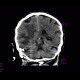 Stroke, cerebral ischemia, acute stage, MCA, medial cerebral artery: CT - Computed tomography