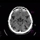 Brain contusion, subarachnoidal hematoma, beam hardening artifact: CT - Computed tomography