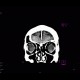 Brain contusion, subarachnoidal hematoma, beam hardening artifact: CT - Computed tomography