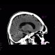 Brain contusion, subarachnoidal hematoma, beam hardening artifact: CT - Computed tomography