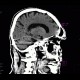 Brain contusion, subarachnoidal hematoma, beam hardening artifact: CT - Computed tomography