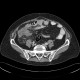 Appendicitis, gangrenous appendicitis, gangrene: CT - Computed tomography