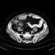 Appendicitis, gangrenous appendicitis, gangrene: CT - Computed tomography