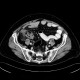 Appendicitis, gangrenous appendicitis, gangrene: CT - Computed tomography