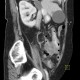 Appendicitis, gangrenous appendicitis, gangrene: CT - Computed tomography