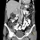 GIST of duodenum, gastrointestinal stromal tumour: CT - Computed tomography