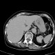 Renal cell carcinoma, multiphase CT, excretory: CT - Computed tomography